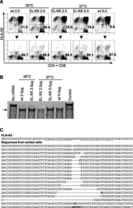 Figure 4. Enrichment of HLA-Aneg primary T cells after genetic editing with ZFNs. (A) Generation of an HLA-A2neg T-cell population. HLA-A2neg T cells were enriched by magnetic bead-based selection. Input dose of mRNA coding for ZFN and 3-day culture conditions (37°C vs 30°C) after electro-transfer of mRNA are indicated. The numbers represent HLA-A2 negative population within the CD4- and CD8-positive population. EL:KK, obligate heterodimer mutant FokI cleavage domain; wt, wild type FokI cleavage domain. (B) Surveyor nuclease assay of the enriched HLA-A2neg T cells. Analysis of T cells enriched for loss of HLA-A2 expression demonstrates disruption in the HLA-A2 locus by the appearance of a fast-moving band (arrow). (C) Sequencing of the HLAneg T cells. PCR products using HLA-A2-specific primers from enriched cell (2.5 μg ZFNs, EL:KK FokI domain, 30°C treatment) were cloned into a TOPO vector (Invitrogen), and plasmid products were sequenced. The wild-type sequence is listed at the top, with the expected ZFN binding sites underlined. Shown below are the sequences obtained from the ZFN-treated and enriched cells. Deletions are indicated by hyphens, and sequence changes are highlighted in bold. All 18 sequence changes result in frame shifts predicted to prevent protein translation.