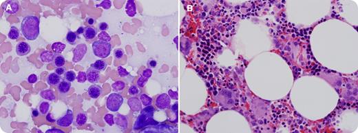 A 73-year-old white male presented to his primary care physician with abdominal pain, vomiting, dyspnea, and dysphagia lasting 1 week. He also reported white patches in his mouth and a cough that produced white sputum that started during this time period. A complete blood count with differential demonstrated severe neutropenia with a white blood cell count of 0.4 × 109/L (absolute neutrophil count, 0 × 109/L; absolute lymphocyte count, 0.3 × 109/L). The peripheral blood smear showed marked leukopenia with no blasts identified. Platelet count was 419 × 109/L and hemoglobin was 108 g/L. On physical examination, the patient was found to be in atrial fibrillation and oral candidiasis was noted. A chest radiograph showed a large mediastinal mass. Computed tomography of the chest showed a 6.6-cm × 4.4-cm necrotic anterior mediastinal mass that involved the phrenic nerve. Bone marrow biopsy revealed hypocellular bone marrow with granulocytic aplasia. Wright-Geimsa stained bone marrow aspirate smear (1000×) with preserved erythroid precursors, but absent granulopoiesis (panel A). The H&E stained bone marrow biopsy sections (400×) similarly demonstrates islands of erythroid development and appropriately distributed megakaryocytes, without maturing granulocytes (panel B). The mass was biopsied and thymic carcinoma (type C thymoma), subtype 1.2.1, epidermoid keratinizing (squamous cell) carcinoma was identified. / Pure white cell aplasia is a rare but recognized complication of thymoma and thymic carcinoma. Severe neutropenia of unknown etiology should prompt evaluation for possible mediastinal mass.