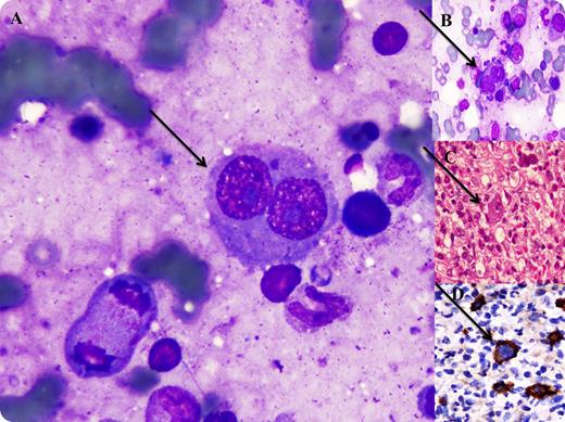 A 40-year-old male presented with weakness, weight loss, and an inguinal mass for 14 months. Hemoglobin was 6.6 g/dL, mean corpuscular volume 89.4 fL, mean corpuscular hemoglobin 29.0 pg, white cells 2.0 × 109/L, and platelets 91 × 109/L. Blood chemistry showed: lactate dehydrogenase 621 IU/L, total bilirubin 1.2 mg/dL, serum glutamic pyruvate transaminase 40 IU/L, alkaline phosphatase 427 IU/L, and serum creatinine 0.6 mg/dL. Histopathology of inguinal mass was consistent with Classic Hodgkin Lymphoma according to WHO classification of lymphoid neoplasms. Staging bone marrow aspirate was a dilute specimen, while touch imprint was cellular with trilineage hematopoiesis. Numerous Reed-Sternberg cells (R-S) were seen in touch imprints (panels A-B). These were large cells having abundant basophilic cytoplasm, bilobed nuclei with eosinophilic nucleoli (marked by arrow). Bone trephine was hyperplastic with diffuse infiltration by inflammatory and R-S cells (panel C) strongly expressing CD 15 and CD30 (panel D). The patient is currently on chemotherapy and is improving clinically. / Bone marrow infiltration is observed in only 5% to 15% of patients with Hodgkin disease. The presence of R-S cells in bone marrow is required for primary diagnosis of lymphoma. This may not be the case if marrow is done for staging purposes. However, careful examination of touch imprints of bone marrow itself can be diagnostic and helpful in the management of the patient.