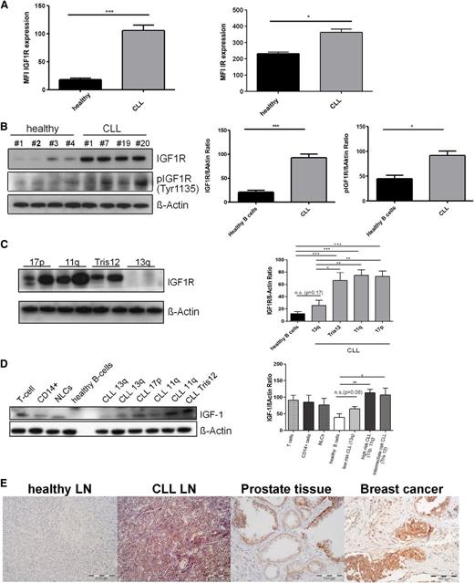 Figure 1. IGF1R and IR expression are enhanced in primary human CLL cells compared with healthy B cells. (A) Healthy B cells or CLL B cells purified from freshly isolated or freeze-thawed PBMCs from CLL patient samples were stained for CD221 (IGF1R; left bar graph) and CD220 (IR; right bar graph), and expression was determined by flow cytometry (n = 10). (B) Healthy B cells or CLL B cells purified from freshly isolated or freeze-thawed PBMCs from CLL patient samples were lysed and analyzed for receptor expression by western blot analysis. Left: A representative example is shown. Right: Densitometric analysis of all samples (n = 20). (C) CLL B cells purified from freshly isolated or freeze-thawed PBMCs of different prognostic CLL subgroups with different genetic aberrations were lysed and compared for receptor expression by western blot analysis. Left: A representative example is shown. Right: Densitometric analysis of all samples (n = 12; mean ± SEM). (D) Healthy B cells or CLL B cells, NLCs, CD14+ cells, or T cells purified from freshly isolated or freeze-thawed PBMCs from CLL patient samples were lysed and analyzed for IGF-1 expression by western blot analysis. The densitometric analysis is derived from 12 different CLL samples (mean ± SEM). (E) Lymph nodes from healthy donors, CLL patients, breast cancer and prostate tissue underwent immunohistochemistry using a polyclonal rabbit antibody against IGF1R. One representative staining is shown for each group.