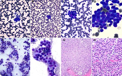 A 55-year-old man was admitted with fever and rapidly progressive renal failure with serum creatinine levels of 6.5 mg/dL and blood urea of 98 mg/dL. Complete blood counts revealed a hemoglobin of 50 g/L, a leukocyte count of 13.3 × 109/L, and a platelet count of 46 × 109/L. Peripheral blood smear examination showed clusters of cells dispersed throughout the smear (panels A-D). These clusters were composed of mononuclear cells, with a rounded nucleus and a scant to moderate amount of basophilic cytoplasm. Occasional circulating myelocyte was also noted. A possibility of carcinocythemia was suggested, and in addition to investigations for the search of primary malignancy, a bone marrow examination was advised. The bone marrow aspirate smears (panels E-F) and trephine biopsy (panels G-H) showed replacement of normal hematopoietic cells by sheets of mature and immature plasma cells. Immunophenotyping on flow cytometry showed a surface expression of CD45 and CD38. The cells were negative for CD19, CD20, CD79b, FMC7, CD22, CD10, CD3, CD5, CD4, CD8, CD138, and CD56. Serum electrophoresis showed the presence of an M-band. Overall, the features were consistent with plasma cell leukemia. The patient succumbed to illness before any further workup or active treatment intervention. / Although rare, this case demonstrates that myeloma cells may cluster in the peripheral blood, similar to tumor cell clusters with carcinoma. The bone marrow biopsy correctly diagnosed myeloma as the cause of the clusters in this case.