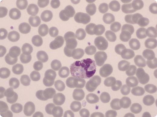 A 96-year-old woman with a past medical history of hypertension, medication noncompliance, and lack of medical follow-up was brought to the emergency room with altered mental status. She was to found to have malignant hypertension with concomitant acute pontine hemorrhage. Her hemoglobin level, hematocrit level, and platelet count were normal. Her white blood cell count was elevated, at 17 200 mcL. Peripheral smear showed leukocytosis with neutrophil predominance. Several neutrophils were noted to have phagocytosed platelets. EDTA-dependent platelet phagocytosis has been previously reported in a young man whose platelet count was 35 000 mcL when collected in EDTA but was normal when collected in sodium citrate or heparin. Although this patient's platelet count was normal, pseudothrombocytopenia can have multiple causes, including platelet clumping, platelet satellitosis of neutrophils, and rarely, platelet phagocytosis. Such phenomena may be induced or enhanced by the anticoagulant EDTA, through the action of EDTA-dependent autoantibodies. / The literature is mixed as to whether EDTA-dependent platelet phenomena occur more frequently in ill or hospitalized patients compared with in healthy control patients. Clinicians should carefully review the peripheral smear when consulted to evaluate a new case of thrombocytopenia. Pseudothrombocytopenia from any cause may lead to extensive and unnecessary workup for thrombocytopenia. Awareness of such phenomena can prevent errors such as delaying surgery, holding medications, or giving unneeded platelet transfusion for purported thrombocytopenia.