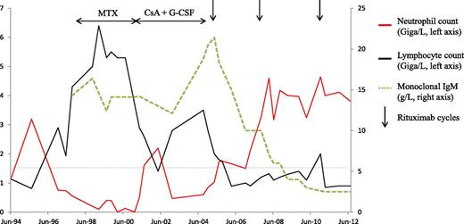Figure 1. Patient 1 with RA. Neutropenia associated with LGLL and monoclonal IgM gammopathy were diagnosed in 1998. Low-dose methotrexate was given from 1998 to 2001 and then stopped because of agranulocytosis with severe stomatitis. Cyclosporine A and G-CSF were started in 2001 and then discontinued in 2004 because of chronic fever and weight loss attributed to monoclonal IgM progression. The first rituximab infusions were given in 2005 and ensured control of the joint symptoms, a decrease in monoclonal IgM titers, and prolonged complete remission of the leukemia. CsA, cyclosporine A; MTX, methotrexate.