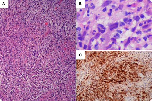 A 63-year-old man with relapsed chronic lymphocytic leukemia with deletion of chromosome 11q initiated second-line treatment with bendamustine and rituximab. Physical examination revealed peripheral lymphadenopathy and a herpes simplex virus (HSV)–like lesion in the right perioral region. After the first cycle, there was rapid improvement in blood counts and lymphadenopathy. However, he developed a new tender mass in the right femoral region measuring 5 cm. Needle biopsy showed extensive areas of necrosis associated with neutrophilic infiltration (panel A). Scattered within these areas of necrosis and in adjacent tissue, atypical cells with ground-glass nuclei were identified (panel B), some of which were multinucleated. An immunohistochemical stain for HSV was strongly positive within the atypical cells (panel C). Focal areas of the biopsy showed chronic lymphocytic leukemia, without evidence of large-cell transformation. HSV immunoglobulin G was reactive. With a diagnosis of HSV lymphadenitis, he was treated with a 10-day course of valacyclovir, resulting in resolution of the right femoral mass. / HSV lymphadenitis is a rare presentation of HSV infection which can occur in patients with hematologic malignancies who are immunosuppressed from their underlying disease and its treatments. Generally, it is a self-limited infection that responds well to antiviral therapy.