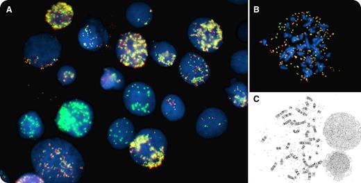 Pancytopenia with circulating blasts was identified in a 79-year-old man. Cytogenetic analysis of unstimulated cultured bone marrow cells revealed a complex karyotype including a variable number of double-minute chromosomes, from 10 to >100 (panel C). Fluorescence in situ hybridization (FISH) analysis, performed with the Vysis MYC break-apart probe set, showed a signal pattern reminiscent of fireworks with bright green and yellow peonies on a black sky (panel A), due to the presence of multiple MYC amplicons. The MYC probe set showed heterogeneity in both the number and the composition of the amplicons, with some cells showing combined amplification of the 5′ and 3′ probes in the form of fused, yellow fluorescent signals, while others presented with only the 3′ MYC probe signal (green) amplification. FISH metaphases showed tens to hundreds of MYC amplicons (panel B). The final morphologic diagnosis was acute myeloid leukemia with myelodysplasia-related changes (WHO classification). / Double-minute chromosomes are rarely but recurrently found in acute myeloid leukemias. They represent gene amplification, and MYC is the gene most frequently involved. The number of double minutes is variable and can reach hundreds as seen in this case.