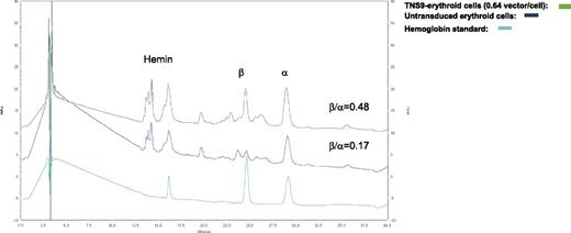 Figure 1. Restoration of β-globin chain synthesis in patient hematopoietic cells.