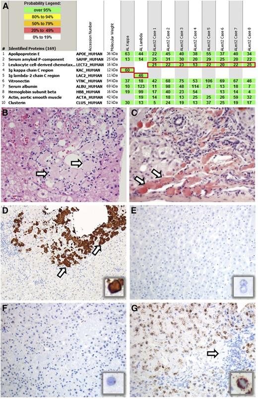 Figure 1. LMD/MS based proteomic findings in 10 cases of hepatic amyloidosis and pathological features of ALect2 amyloidosis. (A) LMD/MS read-outs of 2 cases of AL and 8 cases of ALect2 amyloidosis. The proteins identified are listed according to relative abundance based on spectral counts. The first five proteins represent amyloid-associated proteins identified in this cohort, followed by other abundant proteins identified in the deposits. The first two most abundant amyloid-associated proteins (1-2) across the cohort and present in every amyloid type are apolipoprotein E and serum amyloid P-component. The following three proteins (3-5) highlighted by red boxes represent pathogenic proteins identified in these 10 cases. Only one pathogenic protein is present in each case. Rows 1 and 2 represent AL, and rows 3-10 ALect2 amyloidosis. (B-C) Histologic features of ALect2 amyloidosis. There are periportal globular deposits of proteinaceous material (B, arrows) that are strongly Congo-red positive (C, arrows). (B: hematoxylin and eosin, C: Congo red, ×200 original magnification; image acquired using an Olympus DP71 camera and Olympus BX51 microscope.) (D-G) Expression of LECT2 in ALect2 amyloidosis (D-G), normal liver (E), and AL amyloidosis (F). IHC for LECT2 protein labels the globular amyloid deposits in ALect2 amyloidosis (D, arrows and inset), whereas the surrounding hepatic parenchyma is entirely negative. ISH for LECT2 mRNA is negative in normal liver (E, and inset), rare cells are weakly positive in AL amyloidosis (F, and inset), whereas most cells are strongly positive in ALect2 amyloidosis (G and inset; arrow indicates globular amyloid deposits). (D: IHC for LECT2, ×40 original magnification; E-F: ISH for LECT2 mRNA, ×100 original magnification. All images were acquired using an Olympus DP73 camera and Olympus BX51 microscope.)