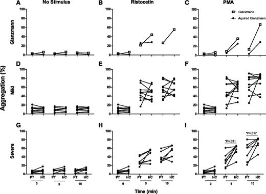 Figure 2. Severe chronic ITP patients show functional defects in platelet microaggregation upon PMA stimulation. An acquired Glanzmann patient, with functional GPIIbIIIa and an anti-GPIIbIIa antibody, and a primary Glanzmann patient, without functional GPIIbIIIa, served as negative controls for the assay (A-C). Eleven mild chronic ITP patients (D-F) and 7 severe chronic ITP patients (G-I) were tested in the platelet microaggregation test. Results are given as percentage of aggregation reached after 0, 5, and 10 minutes without (A,D,G), after ristocetin (B,E,H), or after PMA stimulus (C,F,I). Outcomes are depicted pairwise, the patient compared with a healthy control tested in parallel. Statistical analysis was performed by Wilcoxon signed ranks testing.