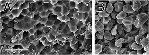 Figure 5. Polyhedral erythrocytes in human coronary artery thrombi. (A-B) Scanning electron micrographs of portions of thrombi aspirated from the coronary arteries of patients with ST-elevation myocardial infarction. Erythrocytes make up only about 11% of the volume of these thrombi, but some are polyhedral. Magnification bar = 10 µm.