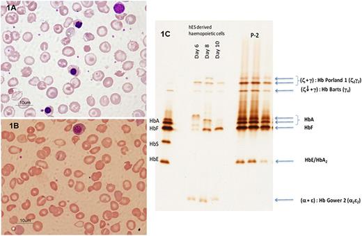 Figure 1. Wright stained peripheral blood pictures from 2 index patients who had normal α- and β-globin genes. In P1 (A), a marked hypochromic microcytosis with anisopoikilocytosis, acanthocytes, and numerous nucleated red blood cells was observed; in P5 (B), a blood picture with numerous fragmented red blood cells with schistocytes and numerous nucleated red blood cells was seen, similar to nonspherocytic hemolytic anemia. Both smears were performed after splenectomy in both patients and were free from blood transfusion. Peripheral blood features in other patients are available in supplemental Figure 1. (C) IEF study of embryonic globins identified in a patient with KLF1 mutations. Comparing hemoglobin profiles from the patient, P2, with control human embryonic stem cell (hES)-derived hematopoietic cells reveals 3 distinct abnormal hemoglobin protein bands separated at a more cathodic position than HbA and HbF. These hemoglobin species were similar to those of patients (P2, in triplication), as they were separated to the same isoelectric points. These hemoglobin bands were subsequently identified by mass spectrometry to be Hb Portland-1 (ζ2γ2) and Hb Bart’s (γ4). Of note, a different level of embryonic protein expression during erythroid differentiation from embryonic to fetal erythropoiesis in hES cells from day 6 to day 10 was observed (Right). Moreover, a fast-moving hemoglobin specie of Hb Gower 2 (α2ε2) was identified in this erythroid cell model but not from the patient. The standard hemoglobin controls are shown on the far left lane.