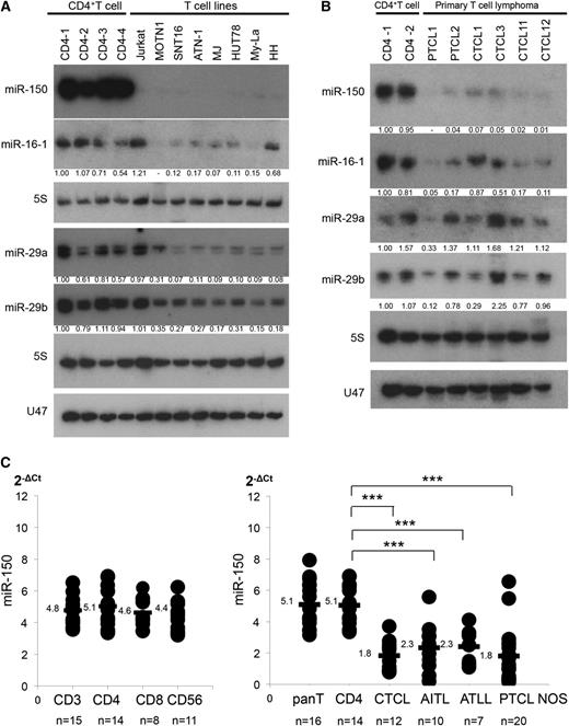 Figure 1. Decreased expression of miR-150 in T-cell lymphomas. (A) Northern blot analysis of miR-150 in T-cell lymphoma/leukemia cell lines. Fold changes in miRNA levels were determined by densitometry and are shown below the gels after normalization to the level of 5S tRNA in normal CD4+ T cells (CD4-1), which were assigned a value of 1.00. Northern blots of miR-16-1, miR-29a, miR-29b, and U47 (another control for 5S tRNA) are also shown. Cell sorter was used to purify CD4+ T cells from lymph nodes or peripheral blood collected from primary samples (>95% purification). (B) Northern analysis of miR-150 in CD4+ T cells (n = 2) and primary samples of PTCL (2 cases of PTCL NOS), and 4 CTCL; 5S served as a control. Northern blots of miR-16-1, miR-29a, miR-29b, and U47 are also shown. (C) qPCR analysis of miR-150. (Left) qPCR analysis of miR-150 in normal CD3+ T cells (n = 15), CD4+ T cells (n = 14), CD8+ T cells (n = 8), and CD56+ T/NK cells (n = 11). (Right) qPCR analysis of miR-150 expression in 49 samples of CD4+ T-cell lymphoma, including CTCL (n = 12), AITL (n = 10), ATLL (n = 7), and PTCL NOS (n = 20). Y-axis: 2-ΔCt values for miRNA expression. Expression levels were normalized by data from PTCL2, which was assigned a value of 1.0; qPCR was conducted in duplicate, yielding similar results. P values were calculated using Mann-Whitney U test. Asterisks (*) indicate statistical significance: ***P < .001.