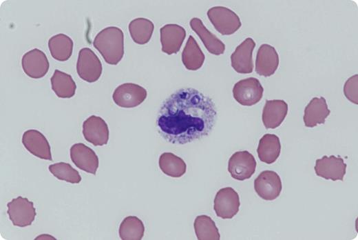 A 51-year-old woman presented with 2 months of fever, chills, diarrhea, dry cough, and progressive dyspnea on exertion. She had a cadaveric renal transplant for immunoglobulin M nephropathy 3 years ago requiring chronic immunosuppression with tacrolimus, mycophenolate, and prednisone. On admission, she had new-onset pancytopenia with a white blood cell count of 2.0 × 109/L (normal range, 3.9-11.7 × 109/L), hemoglobin 6.0 g/dL (normal range, 12-15 g/dL), and a platelet count of 33 × 109/L (normal range, 172-440 × 109/L). Initial peripheral blood smear showed left shift with toxic granulation. On hospital day 3, the patient had a cardiac arrest secondary to acute respiratory failure. On the peripheral blood smear from day 3, hematopathology identified intracellular organisms with thick cell walls and surrounding vacuoles in neutrophils. Liposomal amphotericin was empirically started, resulting in clinical improvement. Cytology from bronchoalveolar lavage and urine antigen confirmed the diagnosis of disseminated histoplasmosis. / The authors thank Dr Kathryn A. Rizzo, Virginia Commonwealth University, for providing the figure.