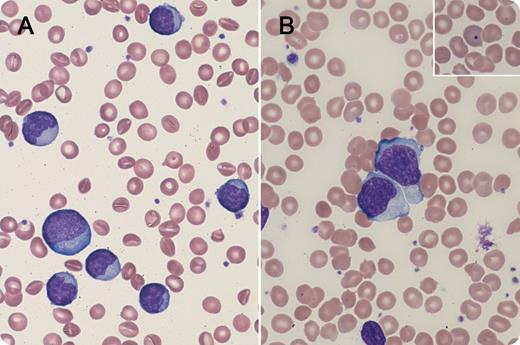 A 7-year-old boy with flu-like symptoms treated with amoxicillin presented with cervical lymphadenopathy; maculopapular rash on arms, face, and trunk; and markedly high white blood cell (WBC) count (100 × 109/L) and high absolute lymphocyte count (85 × 109/L). The peripheral smear revealed a heterogeneous population of lymphocytes (panels A and B). Howell-Jolly bodies were also seen (panel B inset) consistent with his therapeutic splenectomy for hereditary spherocytosis. A monospot (heterophile) test was positive, and serum immunoglobulin M antibody to viral capsid antigen was elevated. Quantitative polymerase chain reaction for Epstein-Barr virus (EBV) was 19 360 copies/mL. Flow cytometry revealed a polyclonal population of T-lymphocytes (85% CD3+, 11% CD3/4+, 70% CD3/8+). Molecular studies showed T-cell receptor β and γ gene clonal rearrangements. The patient was treated supportively and improved clinically. The WBC count decreased to 13.9 × 109/L (Abs lymph: 8.8 × 109/L) over the next several weeks. / This case of infectious mononucleosis is highly unusual in that extreme leukocytosis is rarely associated with reactive conditions. Although clonal rearrangements of the T-cell receptor genes were positive, they were most likely secondary to EBV infection. The peripheral smear morphology demonstrated a reactive proliferation of lymphocytes consistent with EBV infection. Classic clinical findings were also exhibited including a morbilliform rash that developed after empiric ampicillin.