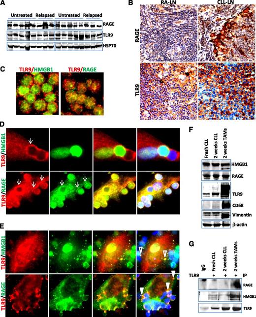 Figure 5. Activation of RAGE/TLR9 in the CLL microenvironment in vivo and in vitro. (A) Detection of RAGE and TLR9 expression in CLL cells by western blotting. Ten untreated and 6 relapsed CLL peripheral mononuclear cells were stored at −80°C and lysed directly from the pellets. Fifty micrograms of proteins was loaded onto each lane. Rabbit anti-RAGE antibody and mouse anti-TLR9 antibody were used at 1:3000 dilution. Hsp70 was used as a loading control. (B) Detection of RAGE and TLR9 expression in CLL-LN and RA-LN by immunohistochemical staining as described in the Materials and methods. Images were taken with a Leixa DM2500 microscope (original magnification, ×200). Immunofluorescent costaining of HMGB1/TLR9 and RAGE/TLR9 in (C) fresh CLL cells and differentiated NLCs after (D) 1 and (E) 2 weeks of in vitro culture. Costained primary antibodies used were mouse anti-TLR9 (red)/rabbit anti-HMGB1 (green) and mouse anti-TLR9 (red)/rabbit anti-RAGE (green) antibodies. Secondary antibodies for costaining were Alexa Fluor 488 goat anti-rabbit IgG and Alexa Fluor 546 donkey anti-mouse IgG. Arrows in D show TLR9 and RAGE aggregation at the contacting sites with CLL cells. Empty and solid triangles in E indicate specified vesicles containing HMGB1/TLR9 and RAGE/TLR9. (F) Expression of HMGB1, RAGE, and TLR9. Proteins were extracted from fresh and 2-week cultured CLL cells and NLCs. Protein expression was detected by western blotting using mouse anti-HMGB1, anti-TLR9, or a rabbit anti-RAGE antibody. CD68 and vimentin were used as markers for NLCs, and β-actin was used for a loading control. (G) Co-IP was performed using mouse anti-TLR9 antibody, and the blots were probed with a rabbit anti-RAGE, rabbit anti-HMGB1, and mouse anti-TLR9 antibodies, respectively. This is a typical result from 3 individual experiments performed.