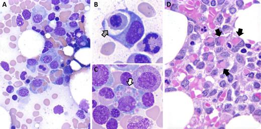 A 61-year-old woman presented to her physician with fatigue. A complete blood count showed mild normocytic anemia. Serum protein electrophoresis and immunofixation identified an immunoglobulin G κ paraprotein (2.1 g/dL). Laboratory values for calcium, blood urea nitrogen, creatinine, and lactate dehydrogenase were normal; no lytic lesions were detected by magnetic resonance imaging. Subsequent bone marrow aspiration and biopsy revealed an infiltrate of atypical plasma cells comprising 20% of nucleated cells, diagnostic of plasma cell myeloma. Many plasma cells contained phagocytosed red blood cells (solid arrows), erythroid progenitors (cross-hatched arrow), and platelets (open arrow) in the aspirate (panels A-C) and biopsy (panel D). By flow cytometry, plasma cells expressed CD38, CD138, and CD56 and were negative for CD45, CD19, CD20, CD27, and CD81. Interphase fluorescence in situ hybridization detected t(4;14)(q16.3;q32), monosomy 13, and deletion of MAF at 16q23. Prominent hemophagocytosis was present in 2 subsequent bone marrow examinations, which showed similar levels of involvement by malignant plasma cells. / Hemophagocytosis by neoplastic plasma cells has rarely been described. On the basis of the few reported cases, hemophagocytosis does not appear to be associated with any recurrent myeloma-associated genetic abnormality, nor is it associated with any particular immunophenotypic characteristics. While cytopenias have been reported in some cases, it is uncertain whether they are a direct result of the hemophagocytic activity of the neoplastic plasma cells.