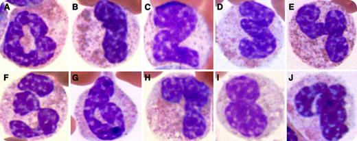 A 32-year-old male presented with a 1-month history of fever, weight loss, and worsening fatigue. Physical examination was remarkable for a temperature of 39.5°C and a massive splenomegaly. A complete blood count showed mild normochromic normocytic anemia and marked leukocytosis (∼90 000/μL), with basophilia (3500/μL), eosinophilia (5000/μL), and neutrophila/bandemia (80 000/μL). No increase in blast count was noted on peripheral blood or bone marrow examination. Cytogenetic analysis showed translocation t(9;22)(q34;q11), so-called Philadelphia chromosome, resulting in BCR-ABL1 fusion. The patient was diagnosed with chronic myeloid leukemia (CML) and began imatinib therapy. / The peripheral smear demonstrated unusually rich polynuclear segmentation generating a complete Arabic numeral list. Panels A through J represent the numbers 0 through 9. This segmentation is secondary to the accelerated myeloid cell production characteristic of CML and other myeloproliferative diseases.