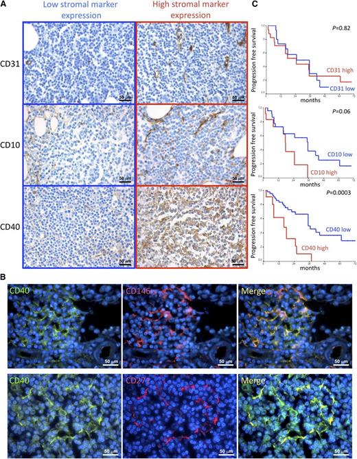 Figure 1. Correlations between CD10, CD31, and CD40 stromal expression and clinical features. (A) Immunohistochemical analysis of CD31, CD10, and CD40 expression (brown signal) on BMB of SMZL patients. The density of CD10+ SCs, the microvascular density, and the expression of CD40 in SMZL BM infiltrates varied consistently among different cases. Representative micrographs of SMZL BM infiltrates characterized by either low (left) or high (right) expression of the 3 markers are shown. Micrographs are relative to 6 of 66 evaluated cases. Immunohistochemistry, STREPTavidin-biotin-peroxidase complex method; original magnification ×400. (B) Double-marker immunofluorescence analysis highlighting the expression of the activation marker CD40 (green signal) by spindle-shaped or stellate BM mesenchymal elements expressing CD146 or CD271 (red signal). The micrographs are relative to a case with high (score 3) CD40 stromal expression. Immunofluorescence with Alexa-488, Alexa-568, and 4,6 diamidino-2-phenylindole fluorochromes; original magnification ×630. (C) Kaplan–Meier curves showing the time to disease progression in SMZL cases subdivided according to CD31, CD10, and CD40 stromal expression.