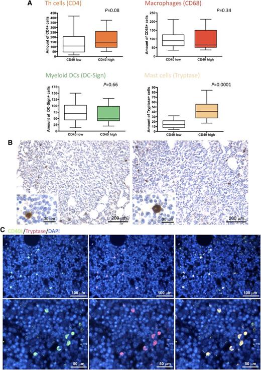 Figure 2. CD40 BM stromal expression correlates with the number of CD40L-expressing infiltrating MCs. (A) Analysis of the number of infiltrating CD4+ T helper cells, CD68+ macrophages, DC-Sign+ myeloid dendritic cells, and tryptase+ MCs in SMZL BM infiltrates, subdivided according to high or low stromal CD40 expression. The degree of CD40 expression on SCs significantly correlated with the number of infiltrating MCs, but not with that of other infiltrating cells. (B) Representative immunohistochemical stainings for CD40L on SMZL BM infiltrates revealing that CD40L (brown signal) is mainly expressed by infiltrating cells with large monocytoid morphology suggestive of MCs (insets) and by scattered small cells with lymphoid morphology. Microphotograph is relative to 1 representative case of the 66 evaluated. Immunohistochemistry, STREPTavidin–biotin–peroxidase complex method, 3,3′-diaminobenzidine (DAB) chromogen; original magnification X100, insets X400; (C) Double-marker immunofluorescence for CD40L (green signal) and tryptase (red signal) expression in SMZL BM infiltrates showing that CD40L-expressing cells mostly coexpress MC tryptase (yellow signal). Microphotographs are relative to 1 representative case with high (score 3) CD40 stromal expression. Immunofluorescence with Alexa-488 and Alexa-568 fluorochromes; original magnification upper panels, ×200; lower panels, ×400.