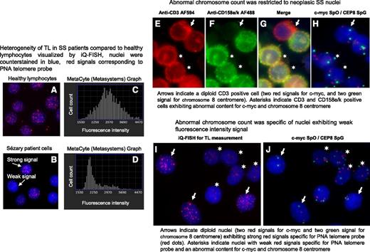 Figure 2. In SS patients, short TL was specific to tumor cells. A and B show nuclei hybridized with peptide nucleic acid (PNA) telomere probes labeled with Cy3 (red dots) and counterstained with 4′,6′-diamidino-2-phenylindole (DAPI) (blue). C and D show distribution of hybridized nuclei number according to their telomere fluorescence intensity values. (A) All nuclei from healthy lymphocytes exhibit a strong fluorescence signal for the telomeres and distribution was normal (C). (B) Two nuclei populations observed in SS patient cells: nuclei with strong fluorescence signals and nuclei with weak fluorescence signals and distribution was bimodal (D). (E-G) Neoplastic SS cells identified by using a double immunostaining detection procedure. (E) Cells were delineated with anti-CD3 AF594 and revealed by an anti-rabbit antibody conjugated with AlexaFluor 594 (AF594; red) and (F) with anti-CD158e/k revealed by an anti-mouse antibody conjugated with AlexaFluor 488 (AF488; green); (G) merged image. (H) Immunostaining detection was followed by a FISH investigation for the same cells using probes specific for c-myc and centromere 8 labeled with SpectrumOrange (SpO) (red spots) and SpectrumGreen (SpG) (green spots), respectively. (I-J) TL identified by using IQFISH followed by a FISH investigation into the same nuclei to reveal chromosome content. Images were acquired by using Isis software (MetaSystems); objective ×63.