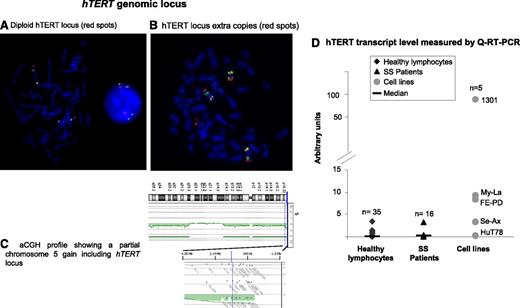 Figure 3. hTERT genomic locus and hTERT expression. (A-C) hTERT status. (A-B) FISH investigation used bacterial artificial chromosome (BAC) probes specific for hTERT labeled with SpectrumRed, 5p13.1 genomic region labeled with SpectrumGreen, and 5q31.2 genomic region labeled with SpectrumGold. (A) hTERT diploid nucleus and metaphase. (B) Metaphase with 3 copies of chromosome 5 and an extra signal for the hTERT locus. Images were acquired by using Isis software (MetaSystems); objective ×63. (C) Array comparative genomic hybridization (aCGH) profile shows that a partial gain of chromosome 5 included the hTERT locus. (D) Real-time qRT-PCR assay to evaluate hTERT mRNA level. Compared with healthy lymphocytes, SS cells showed a slight increase of hTERT transcripts, but this was not statistically significant (P = .29).