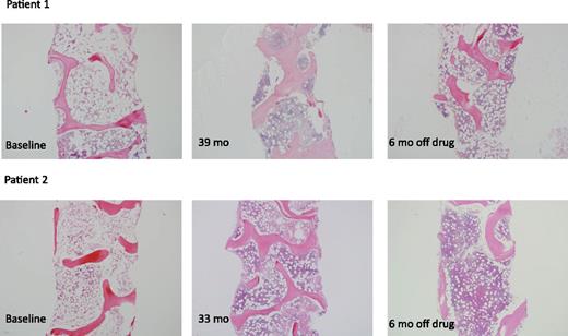 Figure 3. Bone marrow cellularity in patients 1 and 2. The left panels (for both Patients 1 and 2) show cellularity in these robust responders at baseline. The middle panels show cellularity just prior to discontinuing eltrombopag. The right panels demonstrate that, for Patients 1 and 2, the marrows remain cellular. The images were taken on an Olympus BX41 microscope with an Olympus DP72 camera, using a 4× UPlanFL N Olympus objective (original magnification ×40).