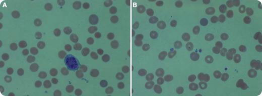 A 74-year-old nonsplenectomized male who had cutaneous squamous cell carcinoma of the scalp with locoregional metastases presented to the emergency room for altered mental status. He had completed metastasectomy and chemoradiation 2 months earlier. Imaging studies revealed no evidence of disease. On admission, he was weak and disoriented and had diarrhea. Complete blood count revealed mild anemia (hemoglobin 11 g/dL) and thrombocytopenia (platelet count 54 × 109/L). His platelets had been normal 3 weeks earlier. Reticulocyte count was 5.56% (0.5% to 2.17% normal range), haptoglobin was <15 mg/dL, and lactate dehydrogenase 540 IU/L (98 to 192 IU/L normal range), consistent with hemolysis. Peripheral blood smear showed moderate anisocytosis, poikilocytosis, polychromasia, and many intra- and extra-erythrocyte parasites, morphologically consistent with babesiosis (panels A and B). The patient’s wife recalled that he had walked in country grass a few weeks before his symptoms started. / Babesia microti can cause hemolytic anemia and thrombocytopenia. The illness usually persists for 2 weeks but fatigue may last longer. Immunosuppressed patients and patients older than age 50 years are more susceptible to this infection, as is the case with our patient. This case underscores the importance of carefully evaluating peripheral blood smear in any patient who presents with cytopenias. His mental status, anemia, and thrombocytopenia improved after antimicrobial treatment.