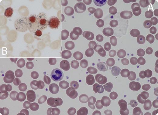 A 63-year-old man presented with symptoms of anemia. The only other symptom of note was some change in personality with unusually aggressive behavior. His blood count was as follows: hemoglobin 65 g/L, white blood cell count 6.5 × 109/L (normal differential count), and platelet count 509 × 109/L. The blood film (panel A) was leukoerythroblastic with target cells and marked basophilic stippling. Liver function test results and hematinics were normal. / On retaking the clinical history, it was noted that he was a painter and had been working on an old house for several months, removing paint. His blood lead level was 4.9 μmL/L (reference range without exposure to industrial lead is 0-0.48 μmL/L) with a high 24-hour urinary lead level of 2130 nmol (normal range, 0-100). These results were consistent with severe lead poisoning. He was treated with chelation with intravenous sodium calcium edetate, intravenous fluids, and zinc supplementation. He obtained gradual improvement in psychiatric symptoms and normalization of blood count. He did not have the usual classical symptoms of lead poisoning. His bone marrow aspirate and trephine morphology showed marked dyserythropoiesis with sideroblastic change and also less marked dysplastic change in the myeloid series (panel B; Perl’s stain).