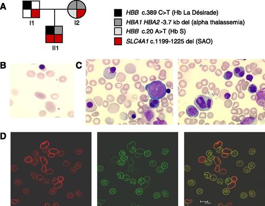 Figure 1. Characterization of homozygous SAO. (A) Pedigree of the family showing HBA1, HBA2, HBB (coding for α- and β-globin), and SLC4A1 genotype. Genetic analyses indicated that the child (II1) inherited a heterozygous 3.7-kb α-globin deletion from the mother, a heterozygous β-globin variant “La Désirade” (resulting from HBB c.389 C>T) from the father, and homozygous SAO. He has not inherited his mother sickle cell trait (HBB c.20C>T). Hb La Désirade is asymptomatic in heterozygotes and could not account for the early severe anemia because β-globin is not significantly expressed at 22 weeks gestation.5 Informed consent was provided according to the Declaration of Helsinki. Approval was obtained from the Bicêtre institutional review board for these studies. (B) Red cell sample from the transfused child contained donor cells as well as large ovalocytes. (C) May Grunwald Giemsa stain of a proband bone marrow sample showed marked dyserythropoisesis, mostly on late erythroblasts, with binuclearity, carrhyorexis, enlarged erythroblasts, and large reticulocytes and macrocytes. Myeloid and megacaryocyte lineages were normal. (D) Confocal microscopic imaging using selected antibodies could differentiate normal transfused cells and SAO red cells in a proband blood sample. Labeling with a polyclonal anti-band 3 antibody (AE1 pAb, red) that binds an intracellular epitope gave stronger fluorescence in the SAO cells than the donor cells (left). This effect was probably attributable to the fragility of the SAO cells, causing the SAO cells to be more readily permeabilized than the donor cells. In contrast, the donor cells could be seen to fluoresce strongly using the BRIC6 monoclonal antibody and a green fluorescent conjugated secondary antibody (middle). An overlay of the 2 images clearly differentiates the homozygous SAO cells from the donor cells, indicating that some SAO cells could survive in the circulation and that SAO band 3 was present at the red cell membrane, even in the absence of wild-type band 3 (right). Scale bar represents 10 μm.