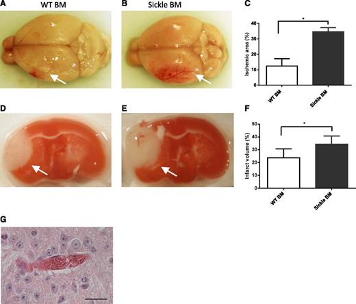 Figure 1. Effect of SCD on stroke after MCA occlusion. At 1 hour following MCA occlusion, the area of erythema representing ischemic zone was greater in SCD compared with WT mice (A-C). At 3 days following MCA occlusion, infarct size by 2,3,5-triphenyltetrazolium chloride staining was larger in SCD mice compared with WT BM mice (D-F). Microvascular occlusions by sickled RBCs were widespread in brain sections of SCD BM mice (G), but not in WT mice. Bar = 50 μm. *P < .05. BM, bone marrow.