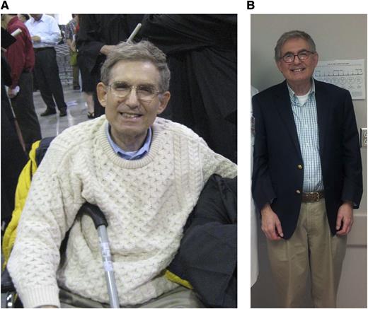 Patient with advanced MF at the start of ruxolitinib therapy (A) April 2008; and currently on ruxolitib therapy (B) January 2014.