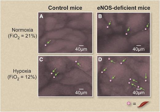 Sickle erythrocytes become adherent (arrows) to bone marrow venules in eNOS-deficient mice infused with labeled sickle cell blood compared with control mice. The number of adherent sickle erythrocytes increases in both control (A,C) and eNOS-deficient (B,D) mice under experimental hypoxia (C-D). This figure has been adapted with color enhancement from Figure 3B in the article by Gutsaeva et al that begins on page 1917. Professional illustration by Debra T. Dartez.