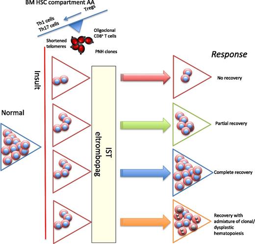 In acquired AA, following an insult (likely viral), there is immune-mediated damage to stem cells, resulting in an inflammatory immune response. There is oligoclonal expansion of cytotoxic CD8 T cells, but the more important component comprises the CD4 T cells, with expansion of Th1 (clonal) and Th17 cells and reduced and dysfunctional Tregs. Two approaches to drug treatment are (1) IST with ATG and ciclosporin and (2) eltrombopag, resulting in direct stem cell stimulation. The different possible responses to treatment are scenario 1, where there are too few HSCs to respond to either IST or eltrombopag (the role of combination therapies is being explored). In scenario 2, there is almost a complete peripheral blood recovery, but biopsy usually shows a hypocellular BM, and often patients have macrocytosis. Scenario 3 shows complete recovery of blood and BM. In scenario 4, there is recovery with emergence of clones (such as −7 or other myeloid-specific mutations), which have a growth advantage, eventually resulting in features of hypocellular MDS. PNH, paroxysmal nocturnal hemoglobinuria.