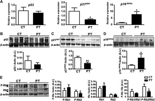 Figure 2. Senescence of PT-ECFCs is associated with changes in expression for cell-cycle checkpoint factors and Rb phosphorylation. p53, p21WAF, and p16 INK4a expression and Rb phosphorylation were assessed as senescence markers. (A) Relative mRNA expression of different cell-cycle markers was determined by quantitative RT-PCR analysis on a Stratagen Mx3000. For each gene, data were normalized to the housekeeping gene RPL13A. Graphs are representative of 4 and 10 samples for CT and PT-ECFCs, respectively. Experiments were performed in duplicate. *P < .05. (B-D) The level of proteins involved in the regulation of the G1 phase was examined by immunoblot on whole-cell lysates from CT- and PT-ECFCs as described in “Patients, materials, and methods.” Representative experiment for p53 (B), p21WAF (C), and p16INK4a (D) in 4 independent CT and PT-ECFCs are shown in upper panel. A total of 30 µg of cell lysate was loaded on 4% to 12% sodium dodecyl sulfate-polyacrylamide gel electrophoresis (SDS-PAGE) gradient under reducing conditions. Blots were probed with anti-p53, -p16 INK4a, -p21WAF polyclonal antibodies or with anti–β-actin polyclonal antibody as loading control. Protein quantification was presented by bar graphs (lower panels) showing means ± SEM of densitometry ratio for each protein normalized to β-actin of 4 independent immunoblots. *P < .05; **P < .01. (E) Changes in the phosphorylation state of Rb were analyzed by immunoblots using antibody against total (Rb) and phosphorylated Rb (P-Rb). Representative experiment is shown. Histograms display normalized staining intensity measured by densitometry. Left, P-Rb to β-actin ratio; middle, Rb to β-actin ratio; and right, P-Rb to Rb ratio. *P < .05