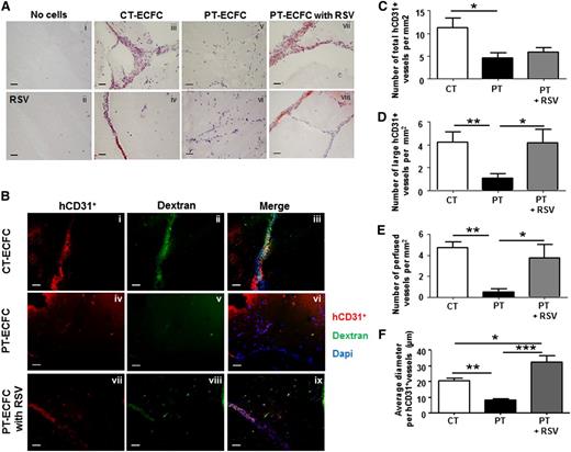 Figure 7. RSV stimulates capacities of PT-ECFCs to form functional blood vessels in vivo. To determine the proangiogenic effect of RSV on PT-ECFCs in vivo, 2 groups of 5-week-old nu/nu mice were injected with a mixture of ECFCs and SMC (ratio 75:25) resuspended in growth factor-reduced Matrigel supplemented with either DMSO or 1µM RSV. Implants were harvested after 7 days and stained with hematoxylin and Fuschin (A) or labeled by fluorescent staining (B) as described in “Patients, materials, and methods.” (A) Representative images of luminal microvessels in sections of Matrigel plugs (original magnification ×20; scale bars, 50 µm). H&F staining showing vessel-like structures in plugs unfilled in the absence (i) or presence (ii) of 1µM RSV and filled with CT-ECFCs (iii-iv), PT-ECFCs (v-vi), and PT-ECFCs treated with 1µM RSV (vii-viii). Images (v,vii) or (vi,viii) were representative of the same sample in the absence or presence of RSV. (B) Representative images of the human vasculature (shown in red by staining against hCD31) and the perfusion in the plugs (shown in green by infusion of Alexa 488–dextran). Nuclei were counterstained with DAPI (blue). Staining showing that vessel-like structures were representative of plugs filled with CT-ECFCs (i-iii), and showing PT-ECFCs in the absence (iv-vi) or presence (xii-ix) of 1 μM RSV. Subpanels iv-ix were representative of the same sample in the absence or presence of RSV (original magnification ×20; scale bars, 50 µm). (C) Quantification of the overall microvascular density of the human vessels per square millimeter (n = 5-7 mice). (D) Quantification of large microvessel density per square millimeter (n = 5-7 mice). (E) Quantification of perfused human vessels per square millimeter, as shown by Dextran labeling (n = 5-7 mice). (F) Quantification of the average diameter of the human vessels (n = 5-7 mice). (C-F) Means ± SEM from 5 nonoverlapping microscopic fields in 5 separate sections per plugs for 5-7 plugs per groups. *P < .05; **P < .01; ***P < .001.