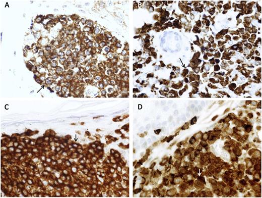 Figure 1. NFAT IHC staining in CTCL samples. (A and B) NFAT IHC detection in 2 different samples from the same patient (38-2 and 38-4, respectively; Table 2); the 38-4 biopsy was taken 14 months later than 38-2. NFAT expression was detected in the cytoplasm in sample 38-2, in which S345F mutation was not found. However, NFAT was expressed in the cell nuclei in the biopsy 38-4 (B) with the S345F mutation. Arrows indicate negative (A) and positive (B) NFAT nuclear immunostaining. (C) NFAT expression in case 50 (Table 2) with wild-type PLCG1. The arrow indicates the cytoplasmic localization of NFAT. (D) NFAT expression in the PLCG1-S345F mutated case 14 (Table 2). In this case, a clear NFAT nuclear staining is detected (objective, 100×, immersion).