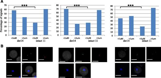 Figure 3. Perinucleolar relocalization of the translocated Ccnd1 allele in MCL patients. (A) Graphs show the distance of FISH signals to the nucleoli. Each graph corresponds to one patient with MCL. Distances have been measured in at least 100 nuclei. ***P < .001. (B) Representative images of double-labeled DNA FISH for each patient. IgH is green, Ccnd1 is red, and nucleolus (B23) is blue. Immuno-FISH and distance measurements were performed as in Figure 2, specifically on cells with the t(11;14) translocation, which were detected by colocalization of the IgH and Ccnd1 signals in the nuclei. Scale bar represents 5 μm.