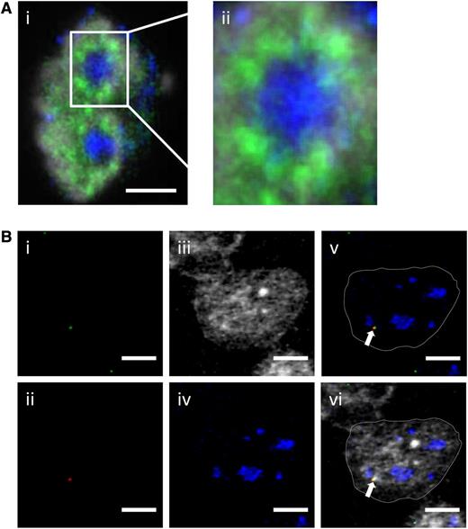 Figure 4. Simultaneous detection of fluorescently labeled transcription factories, nucleoli, heterochromatin, IgH, and Ccnd1 alleles in the Granta-519 MCL cell line. (A) (i) Active RNA PolII (green) and nucleoli (B23, blue) were immunostained with the nucleus counterstained with 4,6 diamidino-2-phenylindole (gray); (ii) enlargement focused on the nucleolus. Scale bar represents 3 μm. (B) IgH (green, i), Ccnd1 (red, ii), active RNA PolII (gray, iii), and nucleoli (B23, blue, iv) were simultaneously revealed by immuno-FISH. In merged images shown in (v) (merged from i, ii, and iv) and (vi) (merged from i, ii, iii, and iv), the arrow points to the der14-carried IgH and Ccnd1 alleles. Scale bar represents 3 µm.