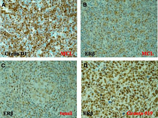 Figure 6. Expression of ERβ in primary MCL tissue. Clear expression of Cyclin D1 (A) and nuclear ERβ (B-D) was detected by immunohistochemistry in MCL patient samples (B), in normal tonsil (C), and in Granta-519 MCL tumors (D). Original magnification ×600. The 4 MCL patient samples showed similar staining intensity.