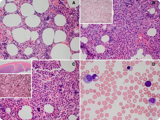 A 65-year-old man received a diagnosis of idiopathic thrombocytopenic purpura (ITP) 2 years ago based on an isolated thrombocytopenia (55 × 103/μL); however, bone marrow showed only increased megakaryocytes, including naked ones (panel A), and cytogenetic studies were unremarkable. The patient failed improvement with steroids, intravenous immunoglobulin, and Rituxan therapy. Also, romiplostim therapy was administered weekly for 4 weeks without improvement. Repeat bone marrow during romiplostim treatment showed hypercellular marrow with 60% to 70% cellularity with increased megakaryocytes and 3/4 reticulin fibrosis (panel B). Repeat marrow was done after the patient was off romiplostim for 6 weeks. The marrow showed progression of the process to a picture of myelodysplastic/myeloproliferative neoplasms (MDS/MPN) with cellularity of 90% with dysplastic megakaryocytes, granulocytosis/myeloid hyperplasia, and 4/4 reticulin fibrosis (panel C). The blood shows leukoerythroblastosis, Pelgeroid polymorphonuclear neutrophils, and blasts (5%) (panel D). / We are submitting a case of MDS/MPN, most likely misdiagnosed as ITP, that progressed rapidly after treatment with romiplostim. Transformation of MDS to acute myeloid leukemia in patients treated with romiplostim has been previously reported, but, to the best of our knowledge, there is no report on progressive fibrosis after the discontinuation of romiplostim. Romiplostim should thus be avoided in MDS patients to minimize the risk of progressive fibrosis or the development of an MDS/MPN-like condition.