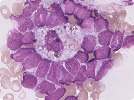 A 64-year-old woman was diagnosed with acute myeloid leukemia (AML-M5) in 2004 and achieved complete response after intensive chemotherapy but relapsed in January 2011. She responded again to induction chemotherapy, but the second relapse occurred in November 2011. At that time, morphologic examination of the bone marrow smear revealed blastic infiltration and the presence of many macrophages with hemophagocytosis, particularly erythrocytes phagocytosis. Surprisingly, several “blastic islands” mimicking physiological erythroblastic islands were also observed, consisting of a central macrophage entirely surrounded by a ring of leukemic blasts. / Although hemophagocytic syndrome is not uncommon in AML patients undergoing chemotherapy, this picture is very rarely observed. It is noteworthy that leukemic blasts are never targeted by hemophagocytosis. What is the significance of the adhesive interactions between leukemic cells and macrophages? It has been shown that increased CD47 expression by leukemic cells inhibits macrophage activity and is associated with poor prognosis in AML. We speculate here that leukemic cells likely express high levels of CD47 and, in addition, that macrophages may also deliver survival signals to leukemic cells, because no features of cell death are seen in surrounding blasts despite this very close contact.