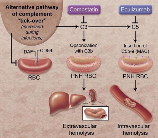 Complement inhibition and hemolysis in PNH. The alternative pathway of complement is continually activated through a process called “tick-over.” Stressors, such as infections, can intensify this process. DAF and CD59 are complement regulatory proteins that are linked to the surface of RBCs by GPI anchors and protect the RBCs from alternative pathway-mediated lysis. However, these proteins are absent from some RBCs in patients with PNH. In these patients, activation of the alternative pathway causes extravascular hemolysis of RBCs by coating the RBC with the C3b fragment, and causes intravascular hemolysis through formation of C5b-9, or the MAC, on the RBC surface. Eculizumab reduces hemolysis by preventing formation of C5b-9. Compstatin prevents the formation of C3b and C5b-9 on PNH RBCs. MAC, membrane attack complex; RBC, red blood cell. Professional illustration by Alice Y. Chen.