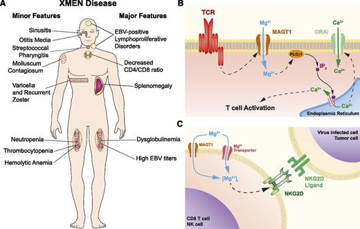 Figure 1. XMEN disease. (A) XMEN disease clinical features. Major features are present in almost all XMEN patients, while minor features are found only in some patients. (B) Model of the role of MAGT1 in TCR activation. In normal T cells, stimulation of the TCR triggers a Mg2+ flux through MAGT1. This transient increase of intracellular Mg2+ is required for the activation of phospholipase C γ1 (PLCγ1) required for the downstream generation of Ca2+ flux through ORAI by promoting the release of Ca2+ from the endoplasmic reticulum via inositol 1,4,5-triphosphate (IP3) and its receptor. (C) Model of role of MAGT1 in Mg2+ homeostasis and NKG2D expression. In XMEN patients, the absence of MAGT1 leads to the chronic reduction of intracellular free Mg2+, which is required to maintain the expression of NKG2D.