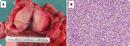A 70-year-old Hispanic woman with history of coronary arterial disease presented with dull abdominal pain and weight loss for ∼2 weeks. A computed tomography scan of the abdomen revealed a large mass occupying the proximal jejunum. The patient had no history of celiac disease or malabsorption. She underwent surgical resection. Grossly, the tumor measured 10 cm in length and had a multinodular appearance with surface ulceration and a soft “fish flesh,” yellow-white, homogenous cut surface (panel A). Microscopically, the tumor consisted of monomorphic small lymphocytes (panel B) positive for cytoplasmic CD3, CD8, CD56, and T-cell receptor γ (TCR-γ), and negative for CD4, CD20, CD30, and TCR-β. / Enteropathy-associated T-cell lymphoma (EATL) is a lymphoma of intestinal intraepithelial T lymphocytes. The World Health Organization divided EATL into 2 variants: a classical form (type I), which comprises 80% to 90% of cases, and a type II or monomorphic variant, which comprises 10% to 20% of EATL cases. The classical form consists of large pleomorphic lymphoma cells which are usually CD3+, CD5−, CD7+, CD8−/+, CD4−, CD56−, TCRβ+/−. Type II is composed of small round monomorphic cells. The tumor cells in type II are CD3+, CD4−, CD8+, CD56+, and TCRβ+. Type I is mostly associated with celiac disease. The monomorphic variant may also be preceded by celiac disease but it has not been well characterized.