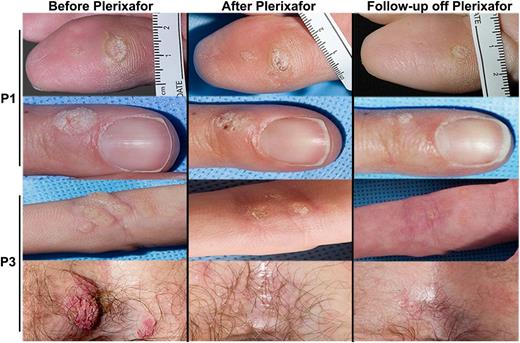Figure 6. Plerixafor with imiquimod may improve warts in patients with WHIM syndrome. Images of representative warts that improved during the trial are shown before and after plerixafor treatment of P1 (rows 1 and 2) and P3 (rows 3 and 4). P1 received imiquimod for the final 2 months of the 6-month trial and continued this drug for 1 year after discontinuation of plerixafor. P3 received imiquimod from the start of the trial until 1 year after its conclusion. The patient is designated on the left of each row. “Before Plerixafor” pictures were taken before the start of the trial and “After Plerixafor” pictures were taken at the end of the trial after 6 months of treatment, while “Follow-up off Plerixafor” pictures were taken 9 months and 1 month after treatment with plerixafor for P1 and P3, respectively.