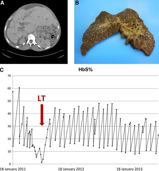 Figure 1. CT scan of liver, explanted liver, and response to exchange blood transfusions. (A) CT liver with contrast pretransplant. CT abdomen with intravenous contrast in July 2011 (just prior to transplant) demonstrated long-standing changes, including a nodular liver with left lobe hypertrophy, biliary dilatation, varices (splenic, umbilical, and retroperitoneal), and moderate ascites. A low-density area in liver segment 3 (probable biliary abscess) was also noted. (B) Explanted liver. (C) HbS% pretransplant, peritransplant, and posttransplant.