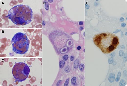 A 47-year-old woman with myasthenia gravis treated with azathioprine, prednisone, and plasmapheresis was admitted for respiratory failure following 2 weeks of fever with splenomegaly, jaundice, coagulopathy, and pancytopenia (white blood cells, 1.1 × 109/L with 64% neutrophils; hemoglobin, 9.5 g/dL; platelets, 79 × 109/L) but no substantial schistocytosis. Triglyceride (330 mg/dL) and ferritin (7562 ng/mL) levels were elevated; fibrinogen level was decreased (52 mg/dL). Soluble CD25 level was markedly elevated (17 092 U/mL), and natural killer cell activity was absent. Plasma was positive for cytomegalovirus (CMV) DNA. Bone marrow examination revealed prominent histiocytic hyperplasia with numerous hemophagocytes (panels A-C). Rare large cells with CMV cytopathic effects (panel D) were also present (confirmed by immunohistochemical staining; panel E). A diagnosis of hemophagocytic lymphohistiocytosis (HLH) accompanied by CMV infection was rendered. / HLH is a systemic inflammatory syndrome associated with impaired cytotoxic activity. Morphologic demonstration of hemophagocytosis is 1 of 8 criteria used to diagnose HLH, but it may not always be apparent at disease onset. Familial HLH has been linked to several specific genetic abnormalities. The etiology of acquired HLH is less clear and may be associated with infection, autoimmune disease, or malignancy. Several reports describe Crohn disease patients on thiopurine immunosuppressive therapy who have developed HLH following CMV infection. This patient eventually recovered following administration of etoposide, dexamethasone, and valganciclovir.