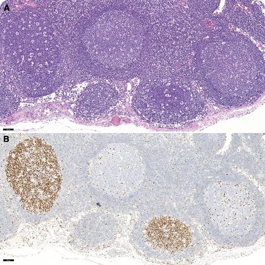 A 12-year-old boy presented with right lower quadrant pain and a 5-lb weight loss. A 4.5-cm ileocecal mass was excised and diagnosed as Epstein-Barr virus–negative Burkitt lymphoma (BL). Numerous pericecal lymph nodes revealed preserved nodal architecture with follicles with intact mantle zones and numerous tingible body macrophages imparting a “starry sky” appearance (panel A: original magnification, ×10; hematoxylin and eosin staining). Closer inspection revealed patchy follicular colonization by BL, which also characteristically imparts a starry sky appearance due to high cellular turnover. This was confirmed by an immunostain for MYC (panel B: original magnification, ×10). / BL is a mature, follicular-derived B-cell neoplasm that harbors a MYC translocation in 100% of cases. Characteristic homing of neoplastic cells to follicular centers may appear deceptively reactive because reactive germinal centers also harbor a starry sky. BL localized to follicles should not be considered an early lesion because it is invariably associated with the presence of aggressive lymphoma elsewhere.