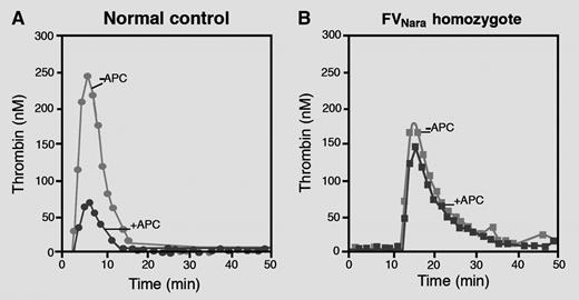 Thrombin generation curves obtained in platelet-poor plasma from a normal control (A) and from the FVNara homozygous patient (B) in the absence and presence of APC. Plasma from the FVNara homozygous patient is completely insensitive to the anticoagulant action of APC. Professional illustration by Marie Dauenheimer.