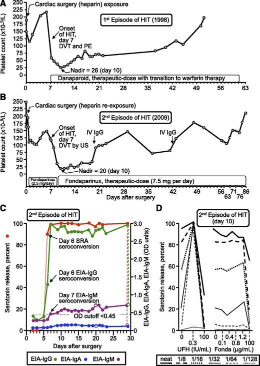 Figure 1. Patient with recurrent HIT after heparin reexposure (patient 17). (A) First episode of HIT (1998). (B) Second episode of HIT after intraoperative heparin rechallenge (2009). The patient’s platelet count rose transiently on 2 occasions after administration of high-dose intravenous IgG. (C) Timing of anti-PF4/heparin seroconversion after heparin rechallenge. Both the EIA-IgG and SRA became positive on day 6; IgM seroconversion occurred on day 7. Reactivity in the EIA in the presence of high heparin (100 IU/mL) is shown by the open circles; thus, the increase in IgM levels was not inhibited by high heparin, whereas the increase in IgG levels and reactivity in the SRA were inhibited by high heparin. (D) Assessment of heparin- and fondaparinux-dependent platelet activation in the presence of patient serum. Strong serum-induced platelet activation (≥80% serotonin release) was observed in the absence of heparin (0 IU/mL) using neat and 1/8 diluted serum; strong heparin-dependent platelet activation was shown by the increase in serotonin release at 0.3 IU/mL UFH, compared with 0 IU/mL UFH, at higher dilutions of patient serum (1/16, 1/32, 1/64, 1/128). The absence of fondaparinux-dependent platelet activation argues against fondaparinux cross-reactivity as an explanation for the patient’s persisting thrombocytopenia. Fonda, fondaparinux; IV, intravenous; PE, pulmonary embolism; US, ultrasound.