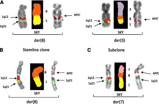 Figure 1. Partial karyotypes of 2 patients demonstrating initial JT1q12 to RC MYC and a second sequential JT1q12 to different RCs. FISH probes 1q12 (red) and 1q21 (green) are shown on the left, SKY image-classified colors for chromosomes 8 (orange) and 1q (yellow) are in the middle, and the FISH probe for MYC (red) is on the right. (A) Patient 1 shows a single copy of JT1q12 translocated to 8q24 (left bracket), and in the same clone, a second translocation of the JT1q12 has translocated an extra copy of MYC to 3q (right bracket). (B) Patient 31 demonstrates a JT1q12 on chromosome 8q24 as the sole 1q aberration in the stemline. (C) In a second specimen analyzed 3 months later, a second translocation of the JT1q12 translocated an additional copy of MYC to 7q23. The sequential translocations of JT1q12 in both cases resulted in a CN increase for both MYC and 1q21 and deletions in the second RCs. Note: In all figures, FISH hybridizations are shown in inverse 4′,6 diamidino-2-phenylindole to delineate chromosome similarities to the G-banding patterns used in routine studies.